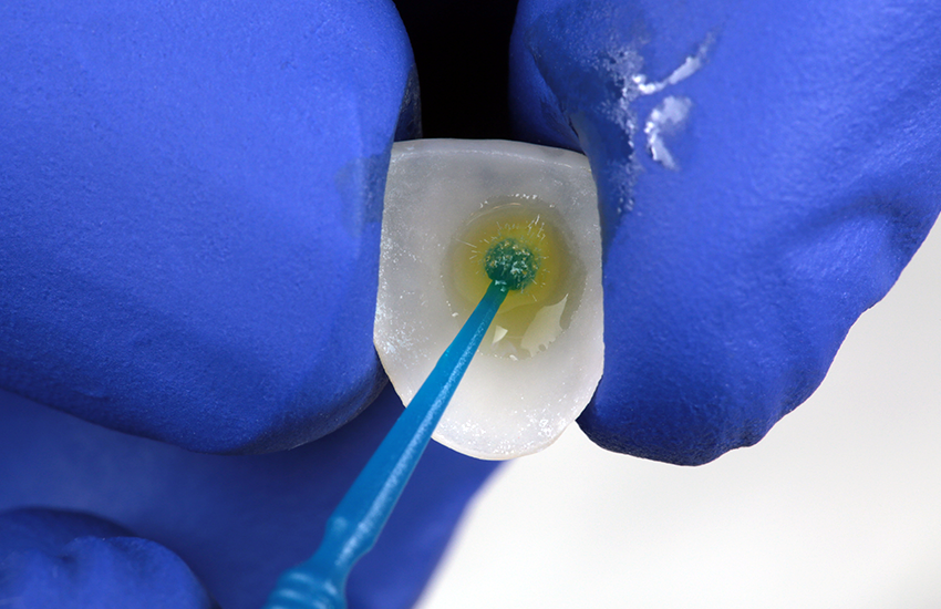 Applikation von 3M™ Scotchbond™ Universal Plus Adhäsiv als Silan auf die geätzte Klebefläche des Glaskeramik-Veneers. Bilder mit freundlicher Genehmigung von Dr. Paulo Monteiro.